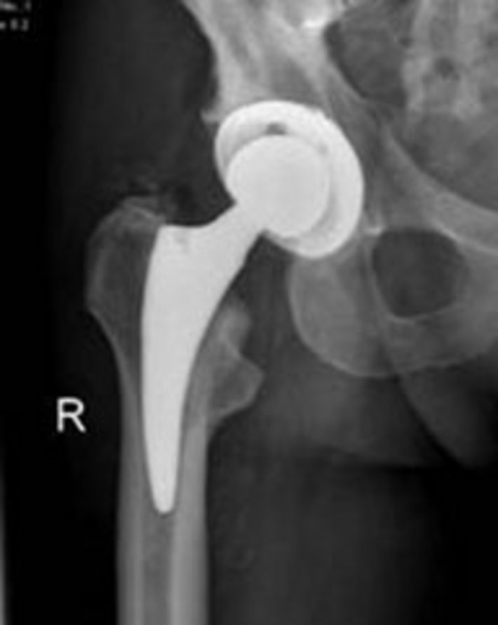 Kurzschaftprothese Hüfte (Foto: Klinik für Unfallchirurgie, Orthopädie und Sportmedizin) Kurzschaftprothese Hüfte