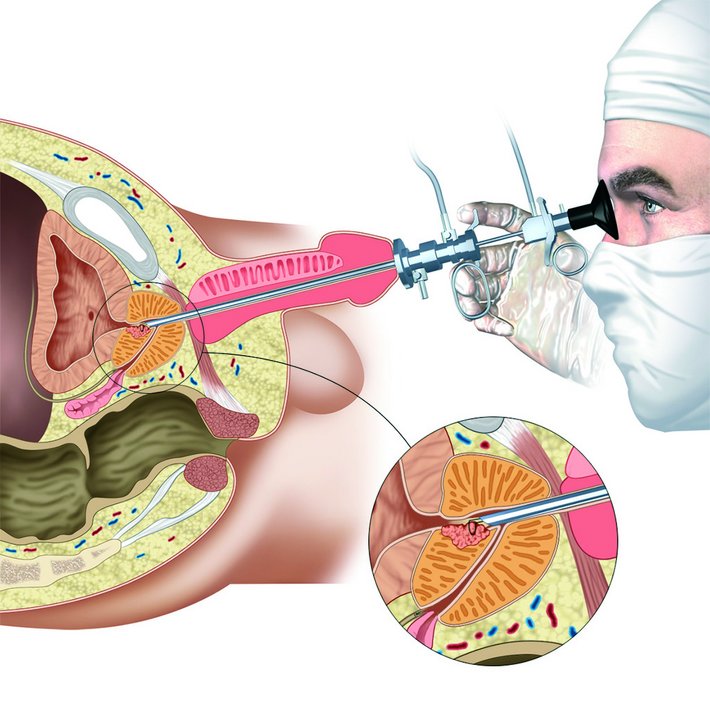 Transurethale Resektion bei gutartiger Prostatavergrößerung