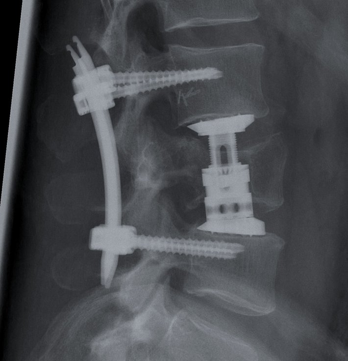 Röntgenbild Lendenwirbelsäule nach OP (Foto: Klinik für Unfallchirurgie, Orthopädie und Sportmedizin) Röntgenbild der Lendenwirbelsäule nach minimalinvasiver OP, bei dem ein Titankorb eingebracht wurde.