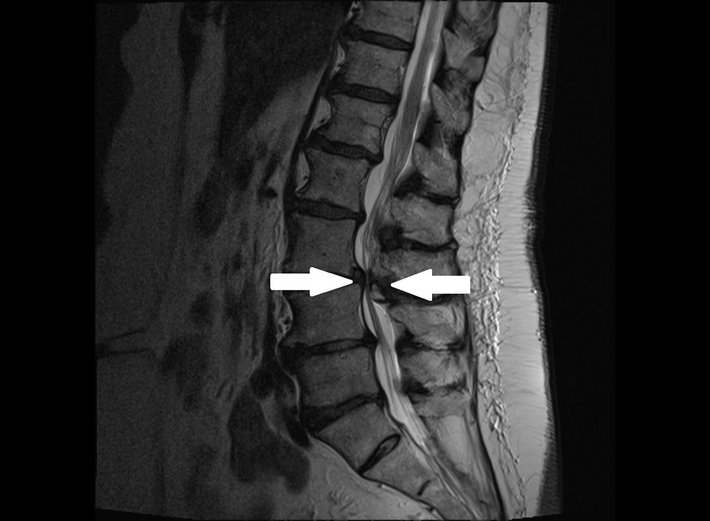 Spinalkanalstenose der Lendenwirbelsäule (Bild: Barmherzige Brüder Regensburg) Von vorne und von hinten kommt es bei der Spinalkanalstenose der Lendenwirbelsäule zu einer Engstelle, bei der die Nerven in die Zange genommen werden.