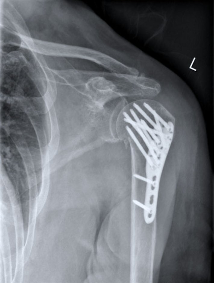 Oberarmkopfbruch nach OP (Foto: Klinik für Unfallchirurgie, Orthopädie und Sportmedizin)