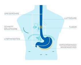 Speiseröhrenkrebs vor OP (Illustration: Franzi Unglaub) Speiseröhrenkrebs vor OP