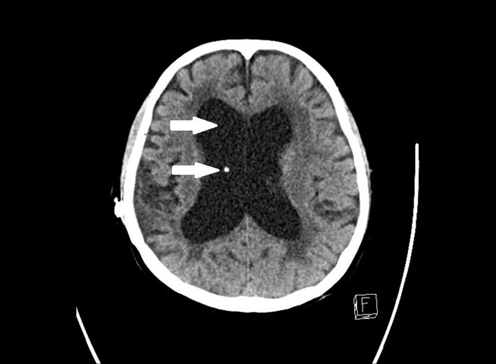 Hydrocephalus (Bild: Barmherzige Brüder Regensburg) Röntenbild: Bei einem Aufstau von Hirnwasser (oben), dem sogenannten Hydrocephalus, wird ein kleiner Schlauch zur Ableitung des Wassers eingelegt (unten).