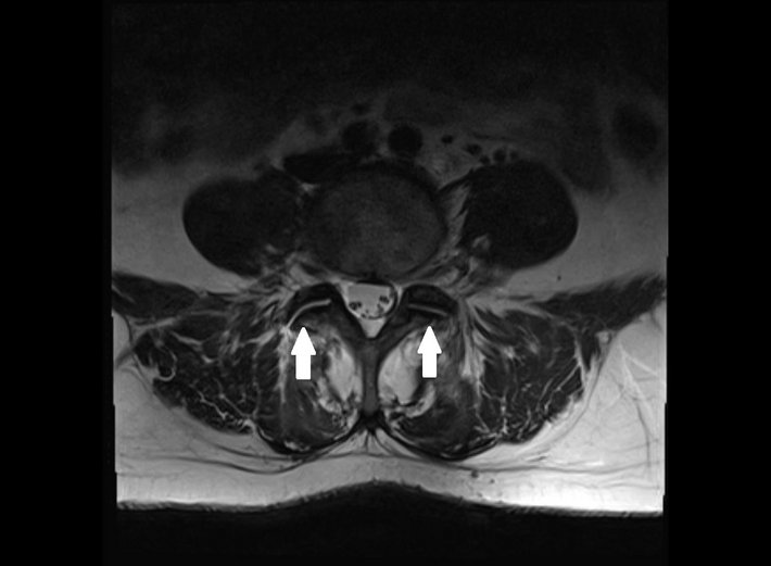 Die kleinen Wirbelgelenke werden bei der Spondylarthrose durch Verschleiß dicker und bilden schmale Gelenksergüsse aus.