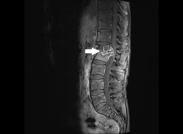 Eine Entzündung der Wirbelsäule (Spondylodiscitis) hat zu einem Einbruch der Wirbelkörper an der Wirbelsäule geführt.