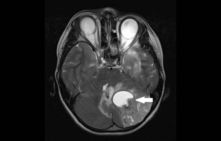 Hirntumor mit Flüssigkeitsblase (Bild: Barmherzige Brüder Regensburg) Dieser Hirntumor (dunkel) im Kleinhirn besitzt eine Flüssigkeitsblase (hell), die zusätzlich auf das Hirngewebe drückt.