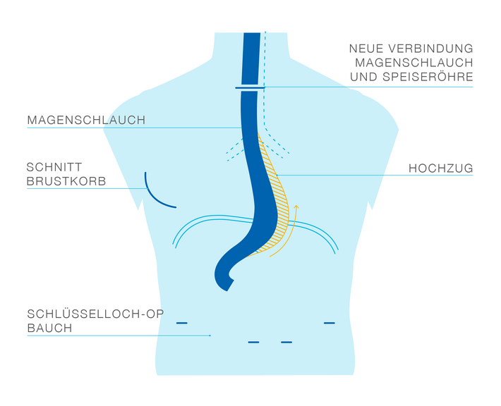 Nach der Operation (Illustration: Franziska Unglaub)