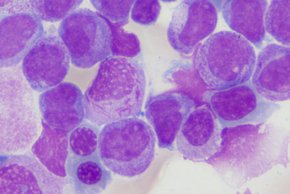 Cellwiki-Preis für das Labor des Krankenhauses Barmherzige Brüder Regensburg (Fotocredit: Sandra Meier.) Zellbild einer akuten Leukämie.