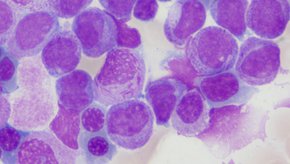 Cellwiki-Preis für das Labor des Krankenhauses Barmherzige Brüder Regensburg (Fotocredit: Sandra Meier.) Zellbild einer akuten Leukämie.